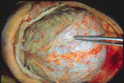 meningit (beyin meningiti)