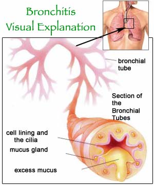 bronxit, ağciyər,tənəffüs,bronchit