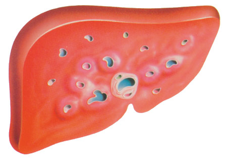 hepatit viruslu qaraciyər