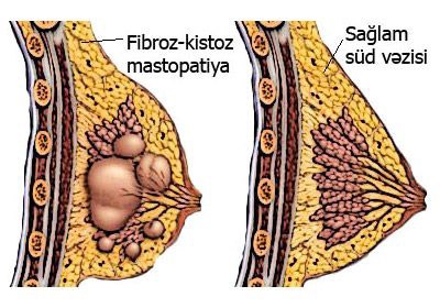 Fibroz-kistoz mastopatiya