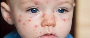 S&uuml;dəmər uşaqlarda alergiya